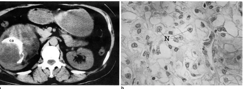 Fig .  3 . Stage 11, grade  111  renal  cell  carcinoma. 