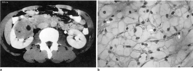 Fig.  5.  Stage  IV, grade 1 renal  cell  carcinoma 