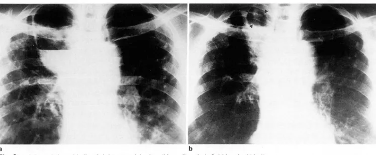 Fig . 3 . a.  A  large infected  bulla of right upper lobe  has thin  wall  and air-fluid  level  within  it 