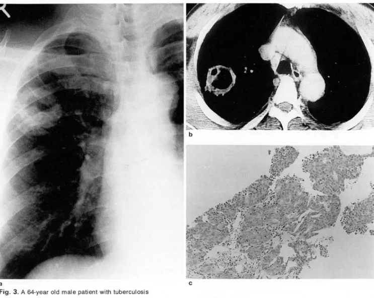 Fig.  3 . A  64-year  old  male patient  with  tuberculosis 