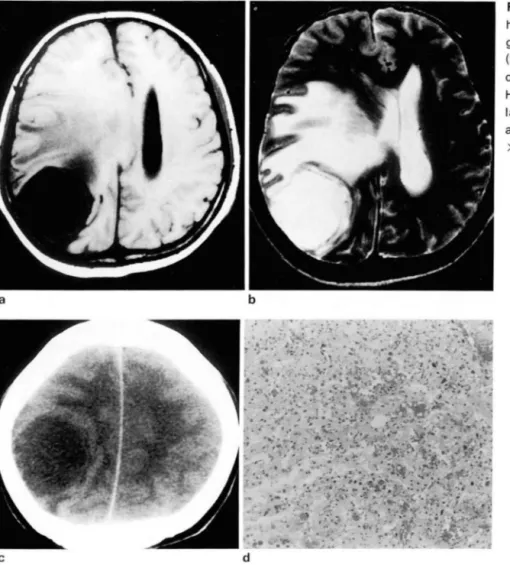 Fig.  2.  Parietal  convexity  meningioma  is  hypointense  on  T1 WI (a) ,  hyperintense  t。