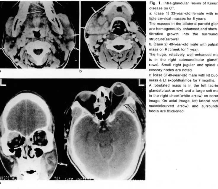 Fig.  1 .  Intra-glandular  lesion  of  Kimura ’ s  disease on  CT 