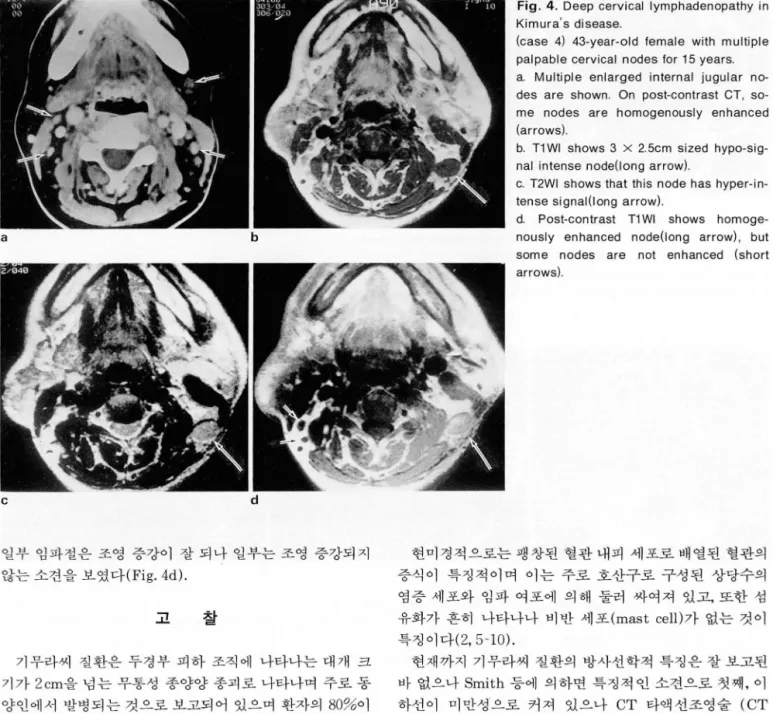 Fig.  4.  Deep  cervical  Iymphadenopathy  in  Kimura ’ s  disease 