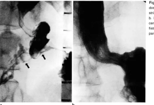 Fig . 2 . a.  Esophagogram  shows  severe esophageal  stricture  at esophagogastric junction 