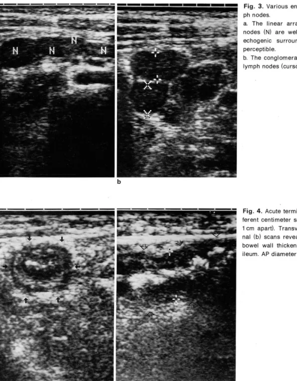 Fig.  3.  Various  enlarged  mesenteric  Iym- Iym-ph  nodes 