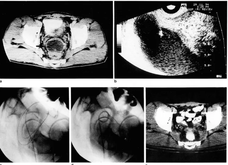 Fig.  2.  a.  CT  scan  of  33-year-old  man  admitted  with  severe  abdominal  pain  and  fever  of  unknown  origi n  shows  an  abscess(ar- abscess(ar-row)  anterior to  the  rectum(arrowhead) ‘ 
