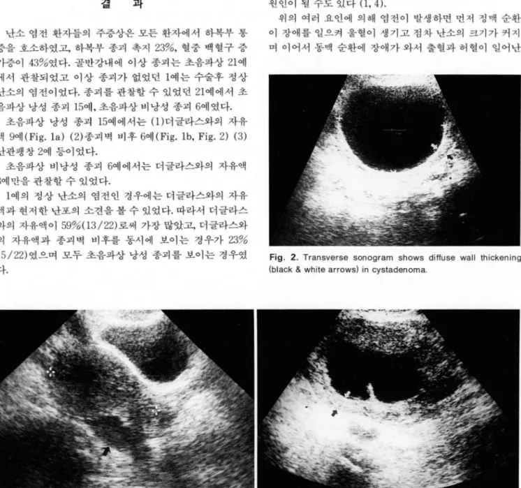 Fig.  1 .  a ,  b.  Longitudinal  and  transverse  sonogram  show  free  fluid  in  Douglas  pouch  and  show  diffuse  wall  thickening  (b lack  &amp; 