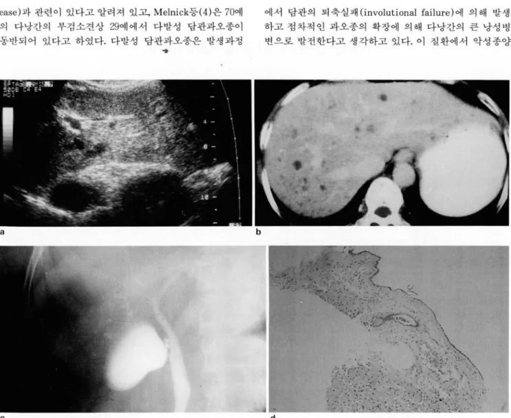 Fig.  1. a.  Transverse  sonogram  through  left  lobe 01  the  liver.  Scattered  hypoechoic  lesions  measuring  up  to  2 cm