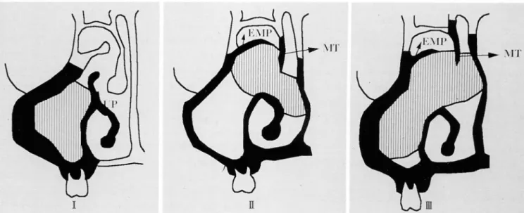 Fig . 1.  Schematic  drawing  of three  patterns  of  maxillary sinus  aspergillosis 