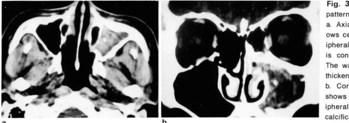Fig.  3 .  Two  cases  with  maxillary  pattern 