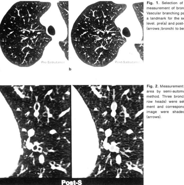 Fig .  1.  Selection  of  the  same  level  for  measurement  of  bronchial  luminal  areas ‘  Vascular  branching  patterns were  used  as  a  landmark  for  th e  selection  of  the  same  leve l