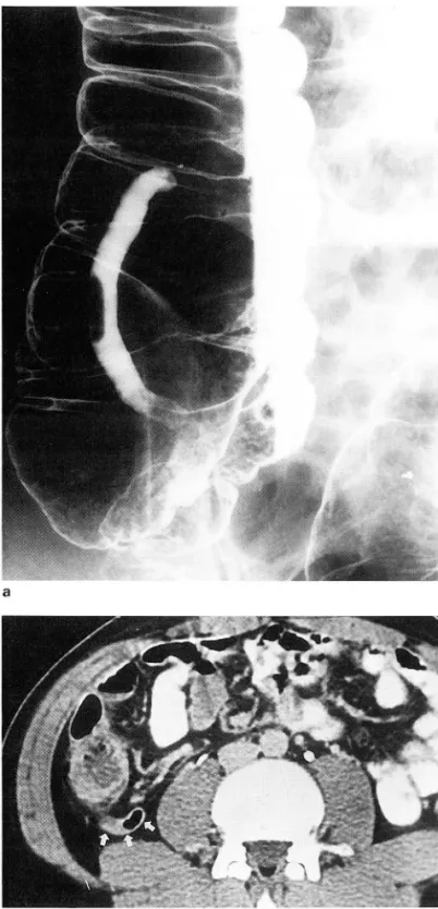 Fig.  1.  Normal  appendix 