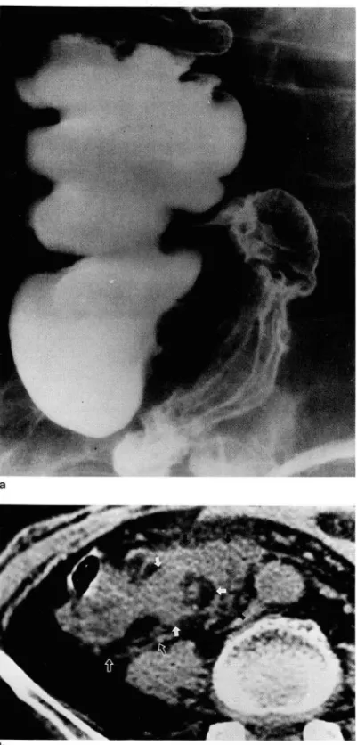 Fig.  4.  Acute  appendicitis  (supprative  type)  in  a  43  year-old  man : 