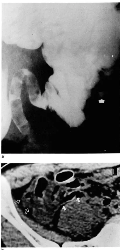 Fig .  5.  Acute  appendicitis  (supprative  appendicitis)  in  a  52  Fig.  6.  Diverticulitis  in  a  58  year-old  man: 