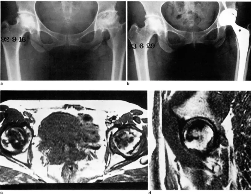 Fig .  1. A  36-year-old  lemale with  AVN  01  both  lemoral  heads 