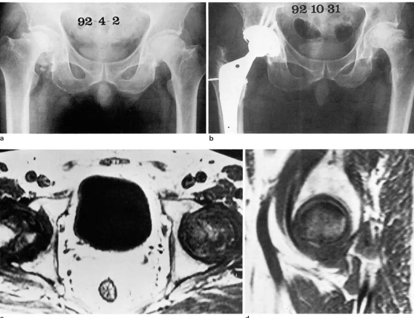 Fig .  3.  A 52.year.old man  with  both  AVN  01 lemoral  head 