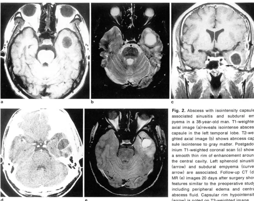 Fig.  2.  Abscess  with  isointensity  capsule ,  associated  sinusitis  and  subdural   em-pyema  in  a  38-year-old  man