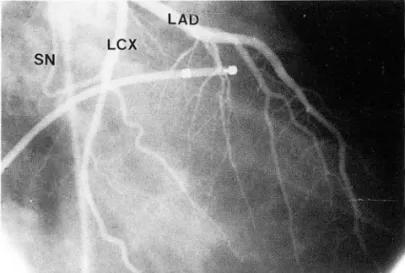 Fig.  6.  Sinus  node  artery  o riginates  from  proxim al  LCX  in  Fig.  8.  Sinus  node  artery  originates  from  proximal  RCA  in  caudal  RAO view  of LCA  i 미 ection 