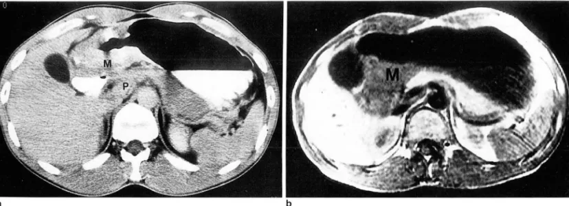 Fig .  2 . Gastric carcinoma  involving antrum 