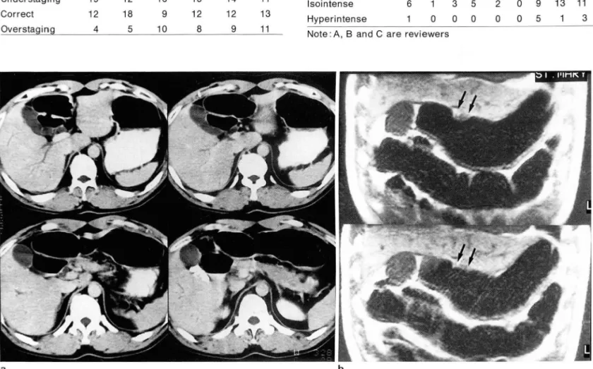 Table  8.  Relative  Signal  Intensity  01  the  Enlargd  Lymph  Nodes to  the  Adjacent Organs(14 cases) 
