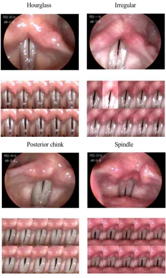 그림 6. 성대결절 환자의 성문폐쇄형태의 예  Figure 6. Glottic closure example of patients in vocal nodules