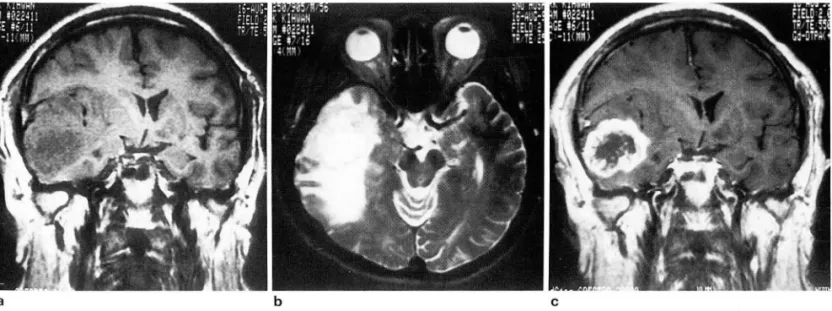 Fig . 1. Glioblastoma multilorme with  central  necrosis 