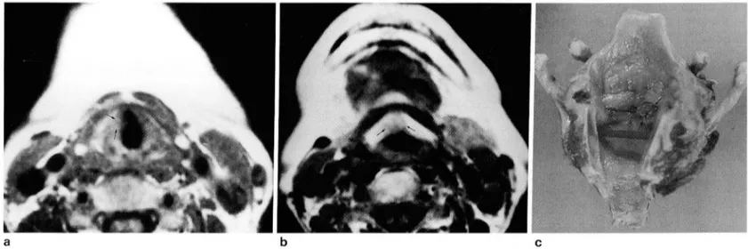 Fig.  2.  Glottic T1b  carcinoma 
