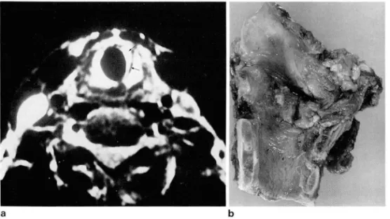 Fig.  4.  Supraglottic T1  carcinoma 