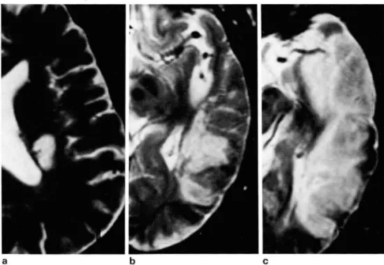 Table  2.  The  Relationship  between  MRI  Extent  and  MRA  Oc- Oc-clusion  Grade 