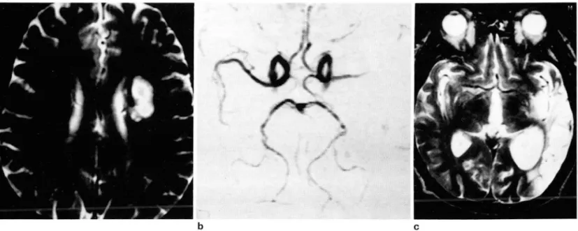 Fig . 6.  Grade  111  and  Extent  I lesion  in  a  61-year-old  patient with  worse clinical  symptoms