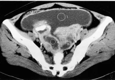 Fig.  4.  Other  CT  lindings  in  complex  ascitic  lorm  01  different  cases 