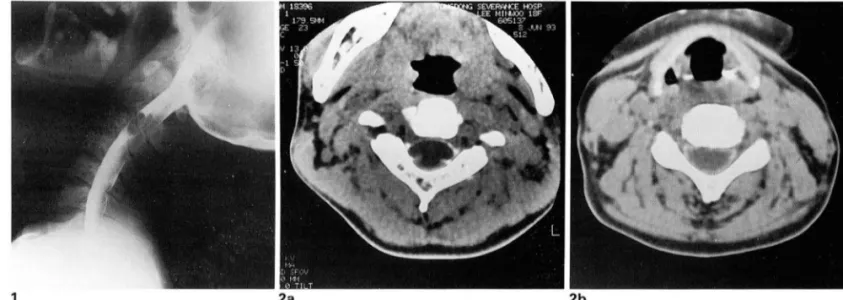 Fig.  1.  Cervical  myelography  shows  a  smooth  lobulated  intradural  extramedullary  filling  defect  at the  level  of C2  and  C3