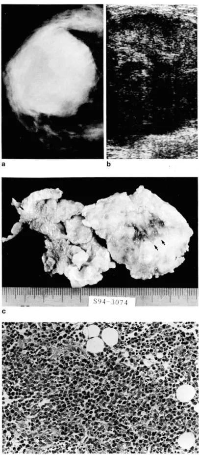 Fig .  1.  Case  1.  A  33-year  old  woman  with  palpable  mass in  right breast 