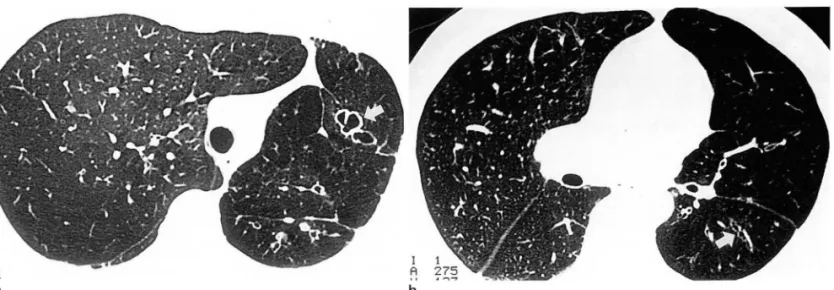 Fig .  3 .  Bronchiectasis  associated  with  Swyer-James  syndrome 