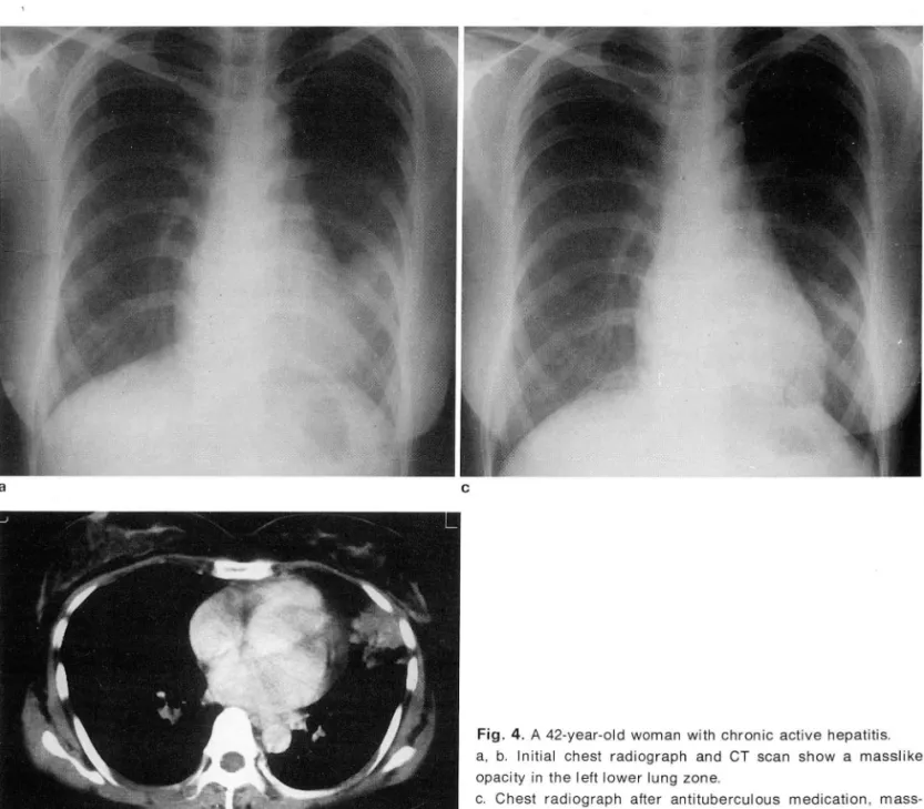 Fig.  4.  A  42-year-old  woman  with  chronic  active  hepatitis  a ,  b.  Initial  chest  radiograph  and  CT  scan  show  a  masslike  opacity  in  the left  lower  lung  zone 