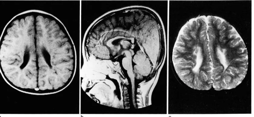 Table 4.  Cerebral  Atrophic  Change  in  Cerebral  Palsy 
