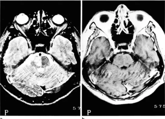 Fig.  1.  Pontine  infarction  in  a  65-year-old  man  with  15-day  history  of  left-sided   wea-kness and  dysarthria