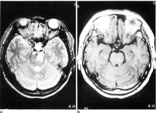 Fig.  4.  Pontine  inlarction  in  a  55-year-old  woman  with  16-day  history  01  right-sided  weakness 