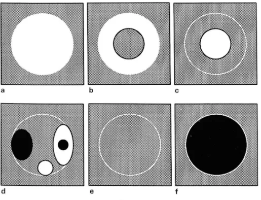 Fig.  1.  Various  enhancement  patterns  01  HCCs: high(a) ,  peripheral  high(b) ,  central  ι 
