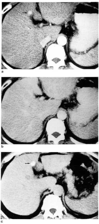 Table  1 .  Contrast  Enhancement  Pattern  01  Hepatocellular  Carcinomas  Smaller  than  3 cm  (n = 152) 