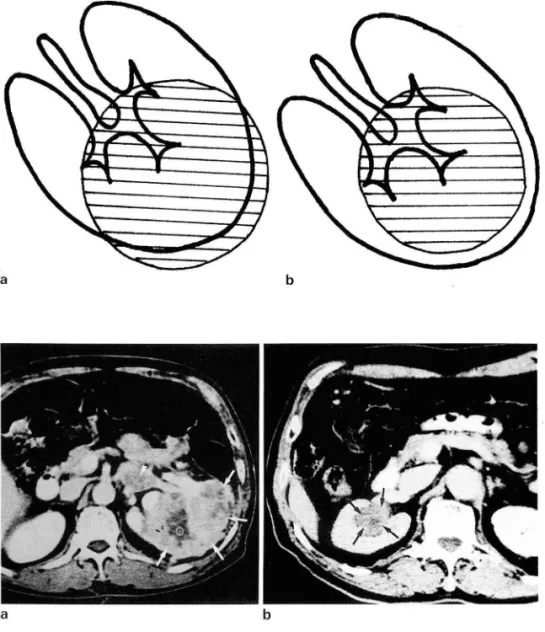 Fig.  1.  Diagram  01  renal  contour  changes  due  to  mass 