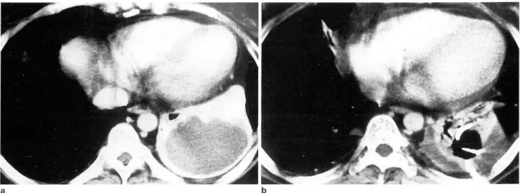 Fig . 1.  Successful  percutaneous catheter  drainage  for  lung  abscess  (case  8)  a