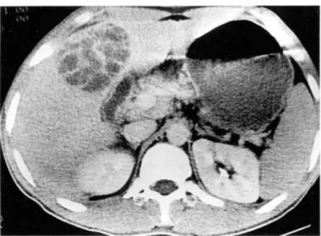 Fig .  1.  Postcontrast  CT  scan  shows  two  well-defined  low  at- at-tenuation  masses  in  the  lobe  right  and  caudete  lobe