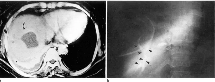 Fig .  3.  a.  Postcontrast CT  scan  shows a  relatively  wel l -delined  mass  in  the right  hepatic  lobe  associated  with  pneumobilia  b