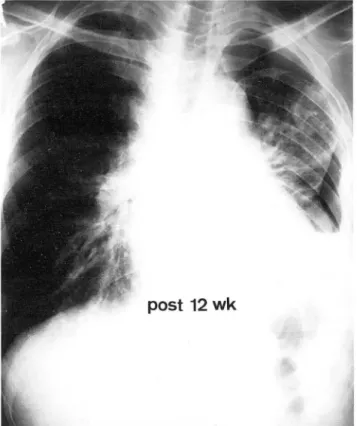 Fig.  3.  Chest  PA  presenting  a  case  of  spontaneous  hydro  pneumothorax developed  in  the  left  hemithorax  12  weeks  after  the  completion  of  6660  cGy  irradiation 