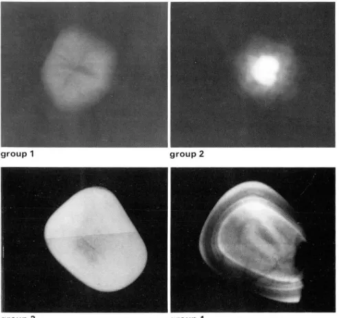 Fig .  1.  Examples  of  calcification  groups  according to  simple  radiographic  finding  group  1  :  lucent 