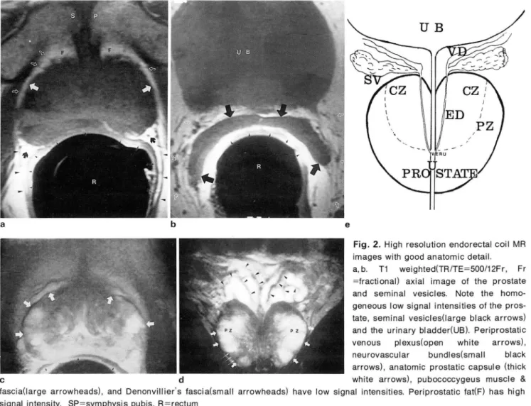 Fig.  2.  High  resolution  endorectal  coil  MR  images  with  good anatomic  detail 