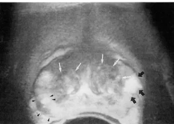 Fig .  3.  Pathologically  confirmed  mucinous  carcinomas  of  the  prostate ‘  Axial  FSE(4000/140 ,  16  ET니  shows  masses  with  hyperintense  foci  in  right  posterior(arrowheads)  and  left  middle  portions  of  the  PZ  (black  arrows)