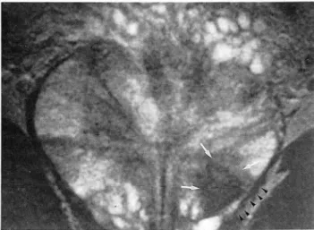 Fig.  6.  A  stage  C  prostate  carcinoma  which  was  correctly  diagnosed  on  MR I