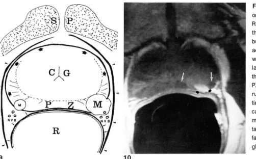 Fig.  9 .  Axial  diagram  01  prostate  carcin-